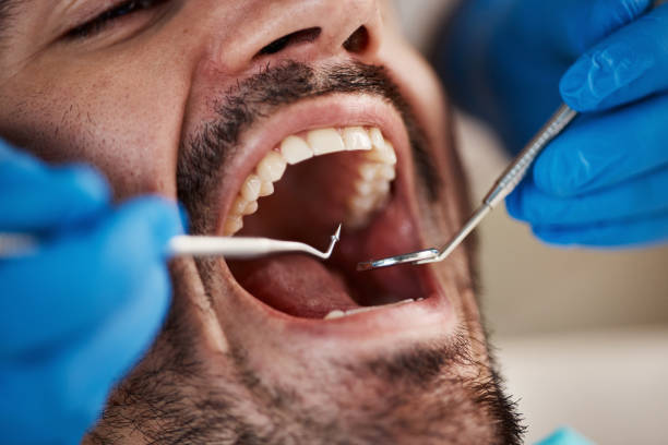 Best Emergency Root Canal Treatment in Apison, TN